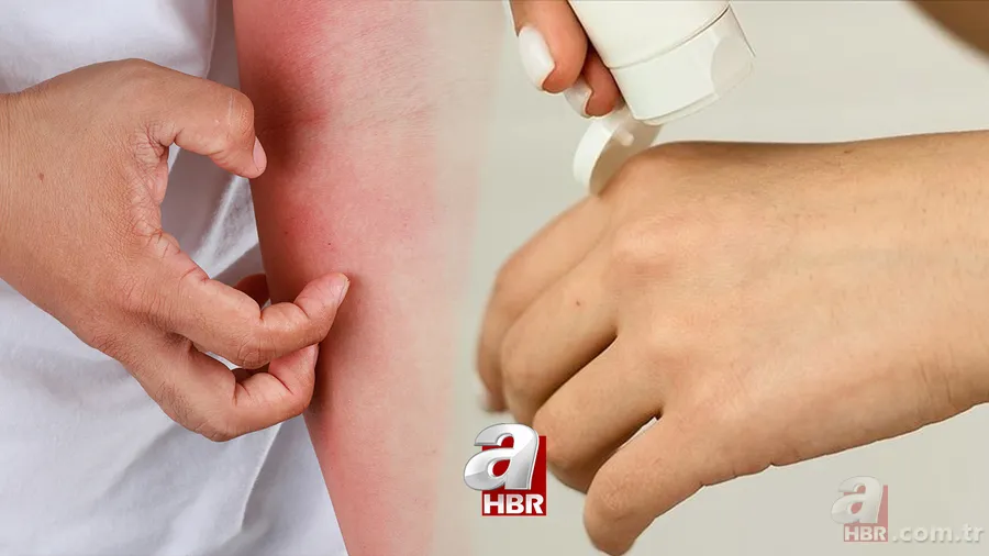 Bu belirtiler varsa dikkat! Ciltte geçmeyen kaşıntı kızarıklık... Uyuz neden olur, tedavi yöntemi nelerdir? Hastalık tanısı... 1