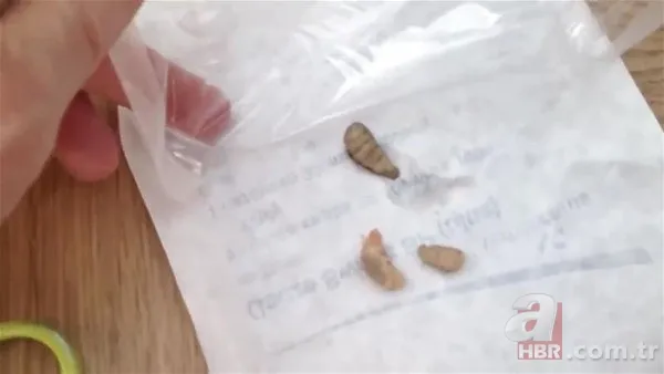 Kolundaki sivilceden böcek çıktı 👩⚕️ Doktora gidince şoke oldu | Cımbızla çektikçe içi gitti 22