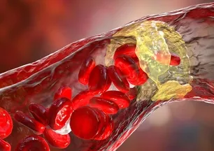 Zeytinyağında bekletip yiyince kolesterolden eser kalmıyor! Doğal antibiyotik...