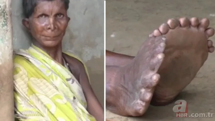 Hindistan’da Polidaktili hastası kadın cadı denilerek dışlandı