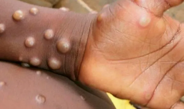 Maymun çiçeği virüsünün belirtileri nelerdir? Ölüm riski düşük ama çok acı çektiriyor | Maymun çiçeğinin iyileşme süreci ne kadar?