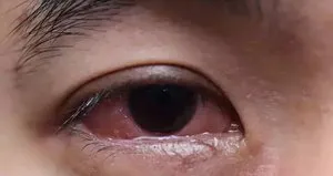 Göz alerjisi neden olur?