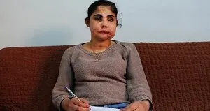 Türkiye’de yüz nakli olan ilk kadın acı haber