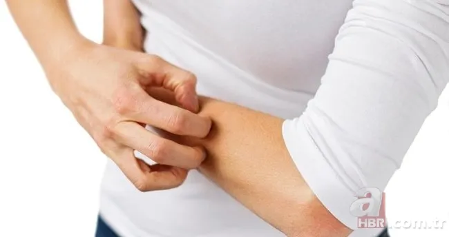 Uyuz hastalığı nedir, belirtileri neler? İnsandan insana uyuz nasıl geçer, kaşıntıya ne iyi gelir, tedavisi var mı? 3