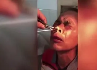 Kan donduran olay! Burnundaki kanamayı durduramadı ve...
