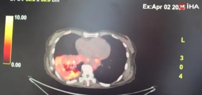 Sigarasız akciğer kanseri vakalarında dikkat çeken artış