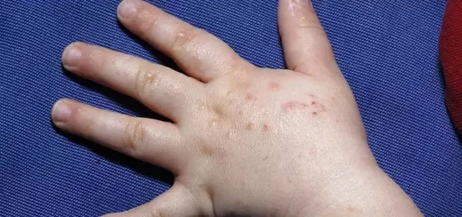Uzmanı uyardı: El ve ayak hastalığı havuz suyundan bulaşabilir!