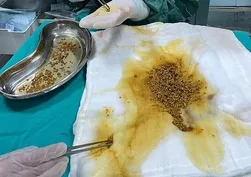 Bingöl'de şaşırtan olay! Hepsi safra kesesinden çıkarıldı