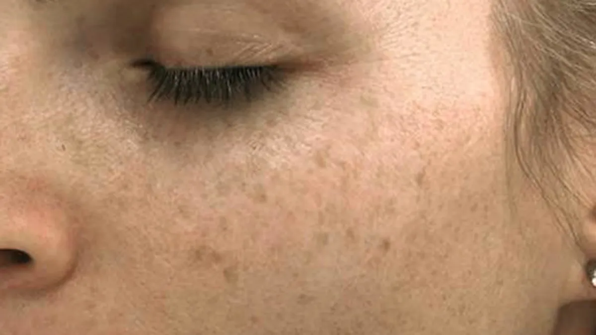 Güneş lekeleriyle mücadelede etkili yöntemler