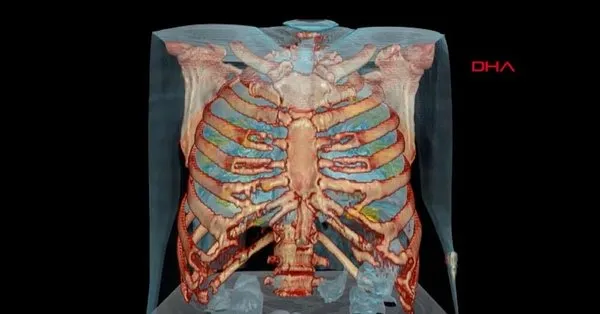 corona virus covid 19 akcigerleri bu