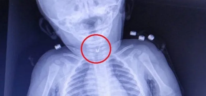 Tekirdağ'da akılalmaz olay! 7 aylık bebek çengelli iğne yuttu