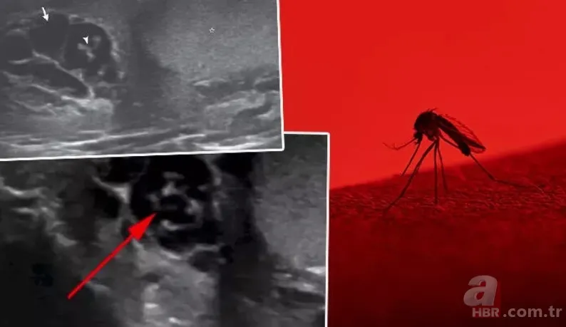 Doktora gitti hayatının şokunu yaşadı 👨⚕️ Sivrisinek ısırığı kabusu oldu 🦟 Dans eden düzinelerce... 1