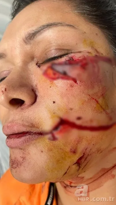 Yüzüne 50’den fazla dikiş atılan Tuğba Altıntop: Köpeğin suçu yok hata bende 2