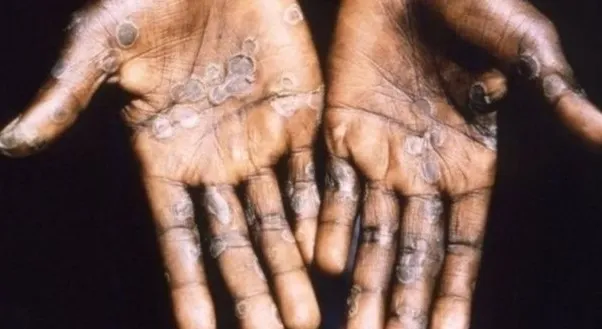 m-cicegi-alarmi-o-bolgede-vakalar-artis-gosterdi-asi-icin-dugmeye-basildi-1724253896632.jpg Afrika'da maymun çiçeğine karşı aşılamalara başlanacak.
