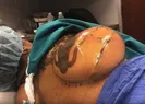 Vücudundan çıkanlar şaşırttı! Doktor bile inanamadı...