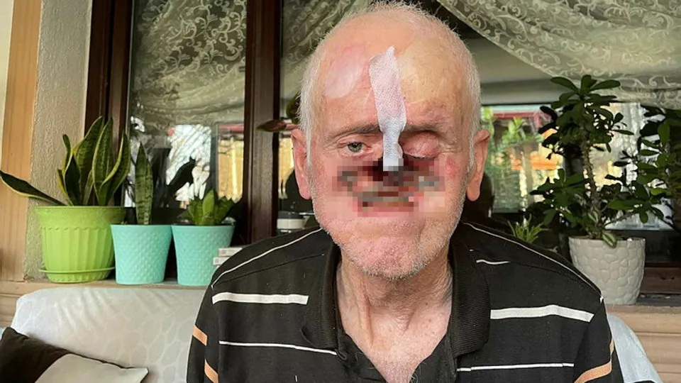 Böylesi ne görüldü ne duyuldu! Burnunda çıkan sivilce hayatını kabusa çevirdi