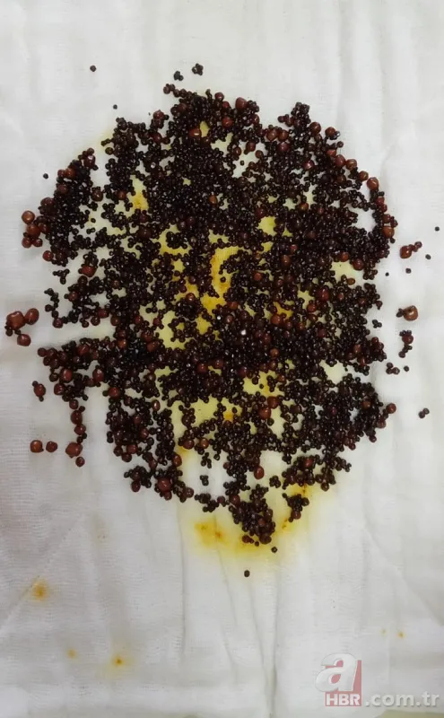 Karın ağrısı şikayetiyle gitti! Safra kesesinden çıkanlar doktorları bile şoke etti 4