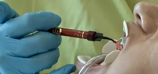 Beyazlatma işleminde yanlış uygulama diş kaybına neden oluyor!