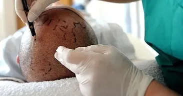 Saç ektirmek için İstanbul’a geldi başına gelmeyen kalmadı!