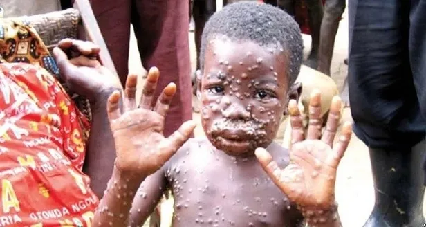 Maymun çiçeği virüsü nedir? Türkiye’de görüldü mü? Maymun çiçeği hastalığı nasıl bulaşır, belirtileri neler?