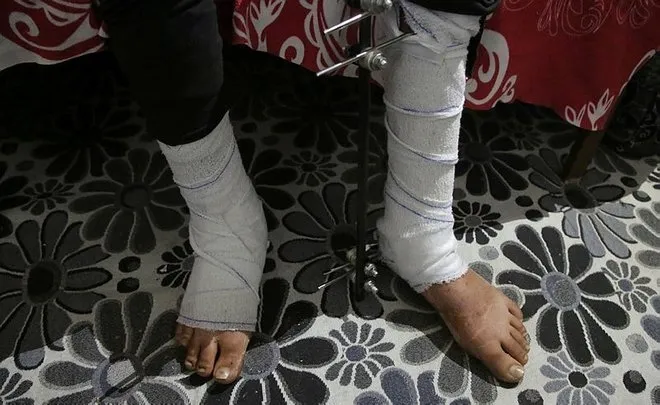 YPG'nin döşediği mayınlar hayatlarını kararttı! 15 yaşındaki Dua Zeki'nin gözü görmüyor, bacakları sakat - 1