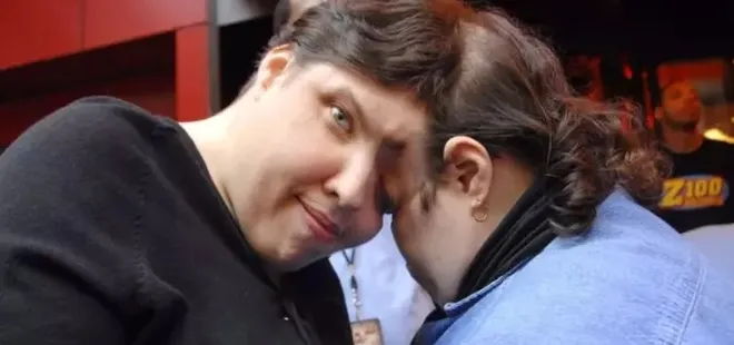 Dünyanın 'en yaşlı' yapışık ikizleri hayatlarını kaybetti! 62 yıl böyle yaşadılar...