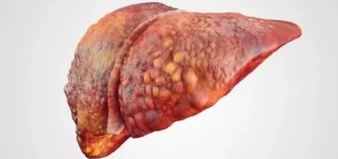 Karaciğer yağlanması bu hastalıklara sebep oluyor