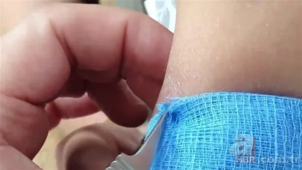 Kolundaki sivilceden böcek çıktı 👩⚕️ Doktora gidince şoke oldu | Cımbızla çektikçe içi gitti 5