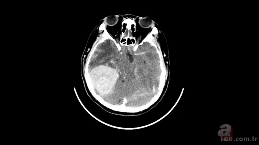 Hastalığını önceden hissetti, hayatı kurtuldu: Tıp dünyasını şaşırtan teşhis hikayesi 2