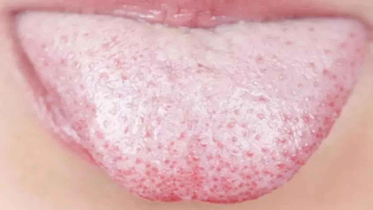 Dil renginize dikkat! O hastalıkların habercisi olabilir...