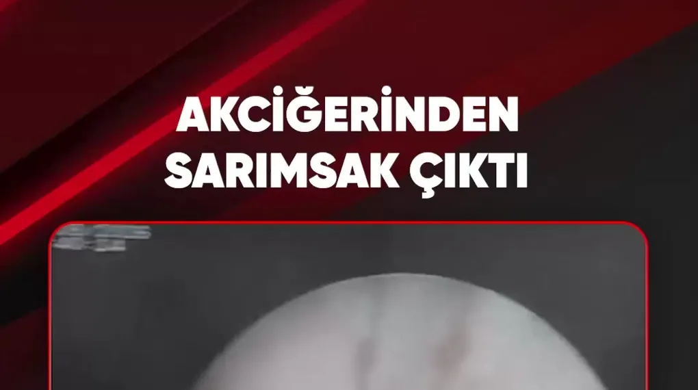 AKCİĞERİNDEN SARIMSAK ÇIKTI