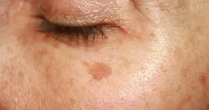 Güneşe uzun süre maruz kalmak cilt lekelerine neden oluyor!