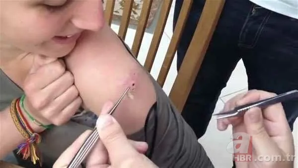 Genç kadının kolundan çıkanlar şoke etti 21