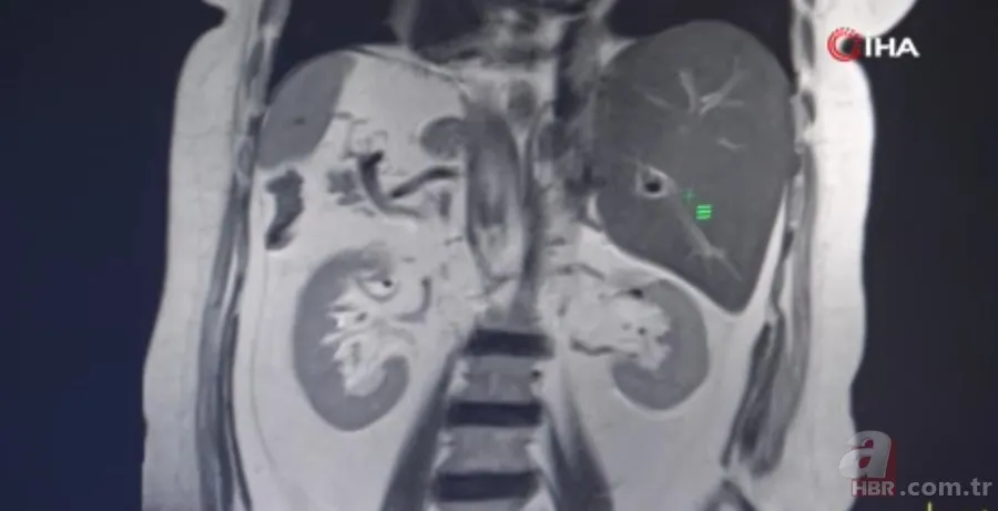 İnanılmaz! Doktorları bile hayrete düşürdü: 66 yıldır iç organları tersine çalışıyor 10