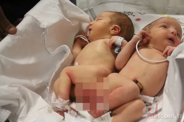 Yapışık ikizler dünyaya geldi 9