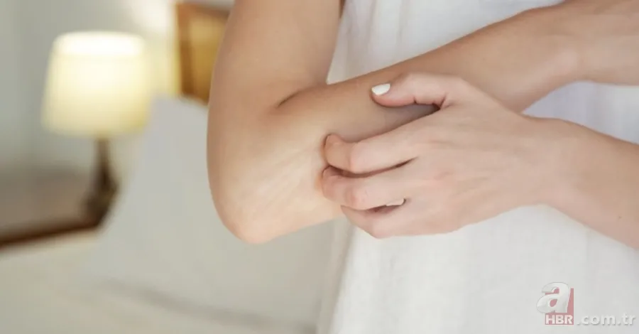 Kuruluğa, kızarıklığa ve acıya son! Eldeki kaşıntı ve egzamayı rahatlatacak yöntem! Tek damlasını sürünce... 6