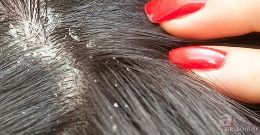 Egzamanızı tek 1 damlasıyla tarihe gömüyor! Saç kökünde kaşıntı, kepek, ağrı şikayetiniz varsa... 7