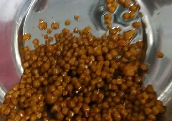 Safra kesesinden 710 taş çıktı