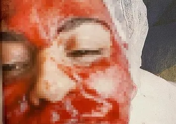 Güzellik merkezinde kabusu yaşadı! Yüzü kanlar içinde kaldı...