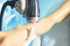 Lazer epilasyon dehşeti! Kabusu yaşadı