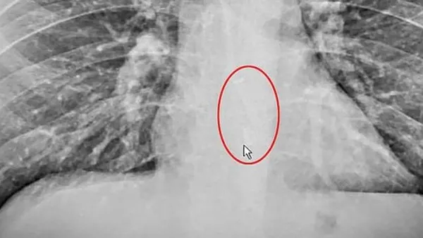 Son dakika: ’Bu kadarı ancak filmlerde olur’ dedirten olay! Uyurken bakın ne yutmuş?