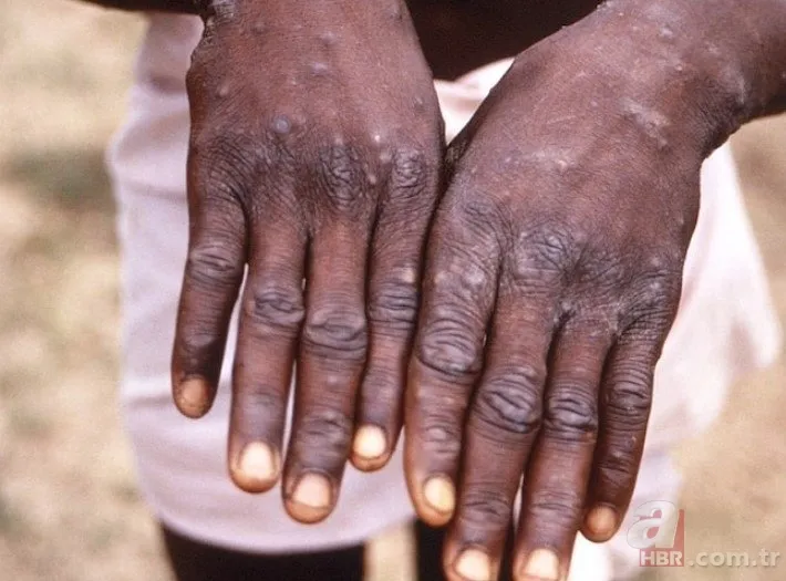 Maymun çiçeği Türkiye'de görüldü mü? Bakan Fahrettin Koca duyurdu! Maymun çiçeği virüsü belirtileri neler, nasıl bulaşır? 10