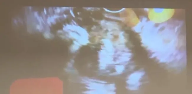 Türk hekimleri kansere karşı yeni yöntem buldu - 1