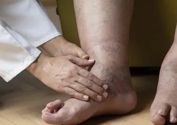 Vücuttaki ödemi söküp atıyor! Bunu tüketen ödem nedir bilmiyor…
