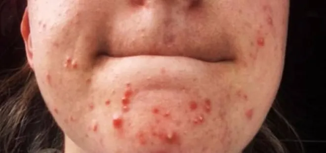 Sivilce ilacı öldürüyordu