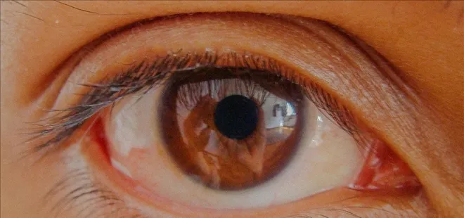 Göz tansiyonunda erken teşhis kalıcı körlüğün önüne geçiyor