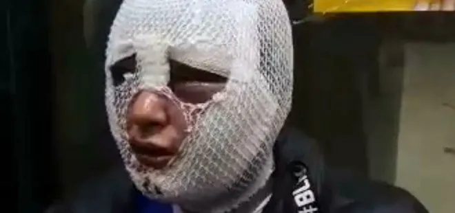 Kız arkadaşının yüzüne kızgın yağ döken eski sevgili tekrar tutuklandı