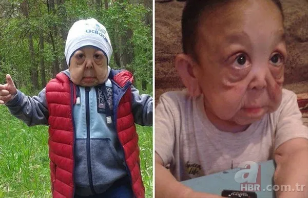 Dünyanın en tuhaf hastalıkları 5