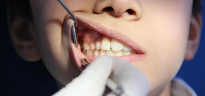 Yaz aylarında çocukların diş sağlığı için önemli uyarılar