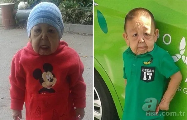 Dünyanın en tuhaf hastalıkları 8